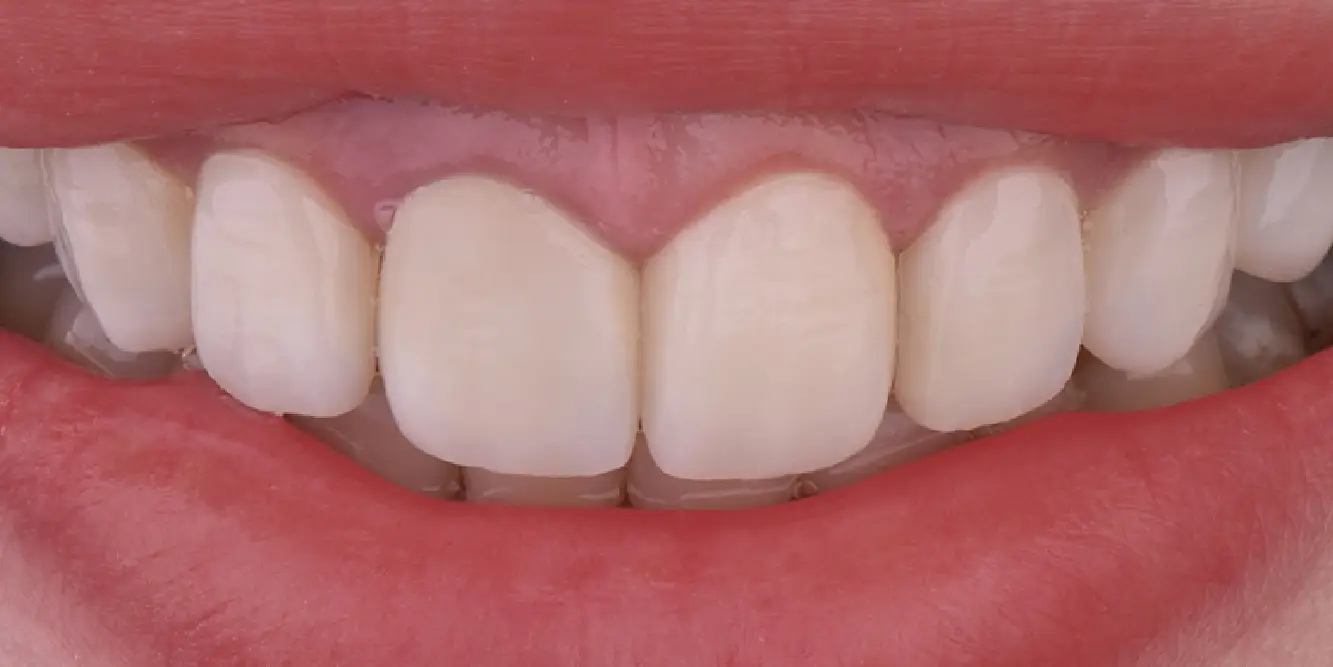 PURE Veneer after treatment